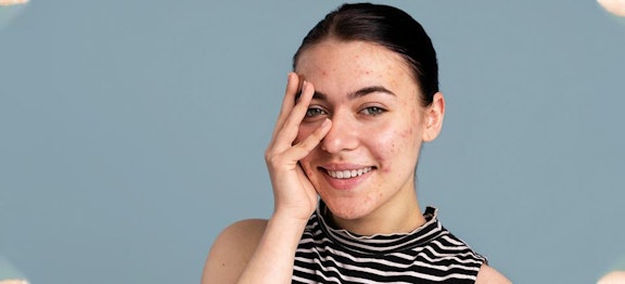 5 Cara Menghilangkan Jerawat Pasir, Wajah Jadi Flawless