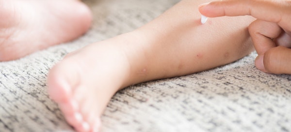 5 Penyebab Kulit Kering pada Bayi dan Cara Mengatasinya
