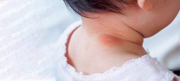 5 Penyebab Ruam di Leher Bayi dan Tips Mengatasinya