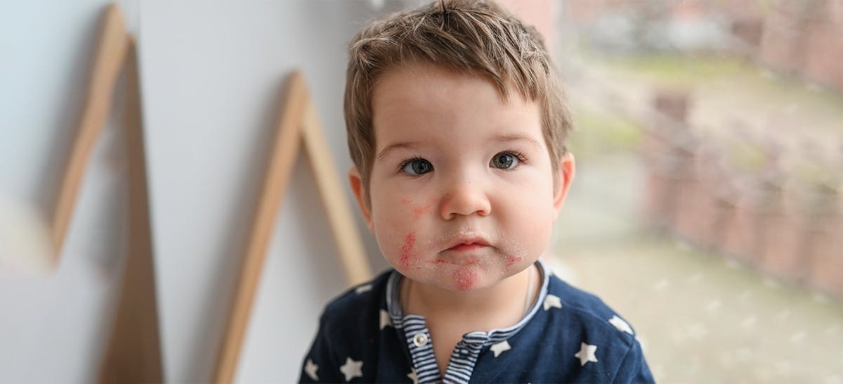 6 Jenis Alergi pada Bayi dan Cara Mengatasi. Yuk, Kenali! - Ibupedia