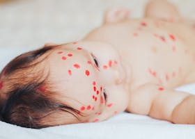 6 Jenis Ruam Bayi dan Cara Menanganinya
