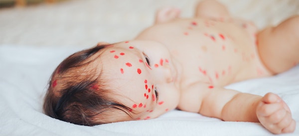 6 Jenis Ruam Bayi dan Cara Menanganinya
