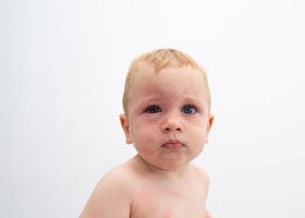 Si Kecil Gatal Kemerahan? Waspada Alergi Kulit pada Bayi
