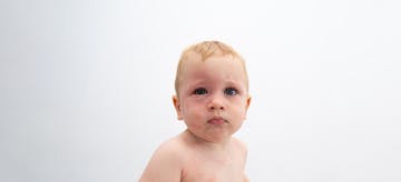 Si Kecil Gatal Kemerahan? Waspada Alergi Kulit pada Bayi