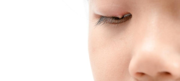 Bisa Ringankan Rasa Sakit, 7 Cara Mengatasi Mata Bintitan Pada Anak