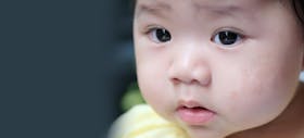 Cara Mengatasi dan Mencegah Kulit Bayi Kering Karena Eczema