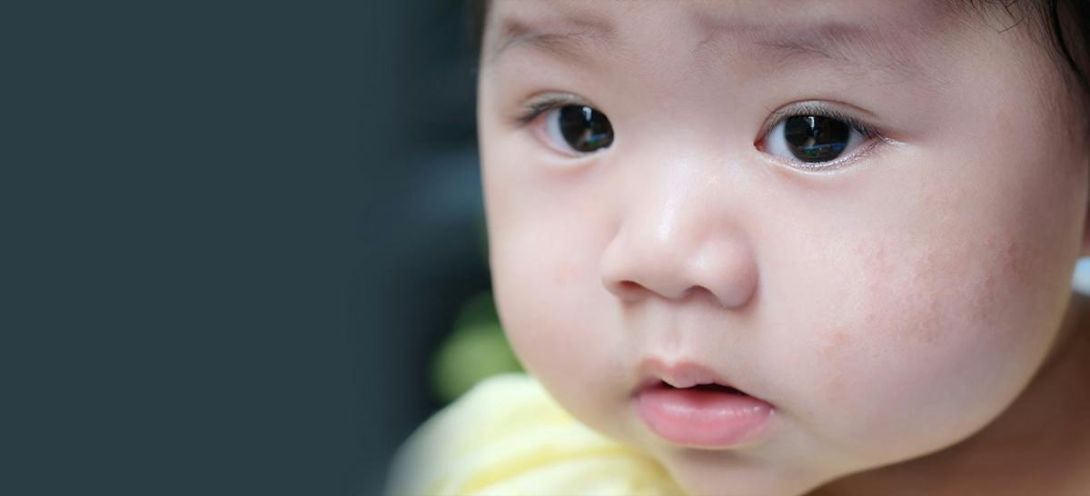 Cara Mengatasi Dan Mencegah Kulit Bayi Kering Karena Eczema Ibupedia