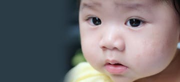 Cara Mengatasi dan Mencegah Kulit Bayi Kering Karena Eczema