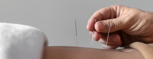 Fakta Baru: Akupuntur Meningkatkan Kesuburan dan Kemungkinan untuk Hamil