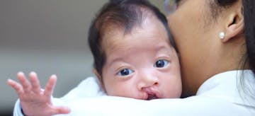 Genetik Dan Paparan Zat Berbahaya, Picu Bibir Sumbing Pada Bayi Baru Lahir