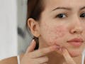 Hilangkan Bruntusan! Rekomendasi Facial Wash Untuk Kulit Berjerawat