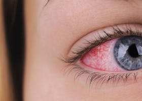 Ini Penyebab Mata Anak Belekan: Virus Atau Bakteri?