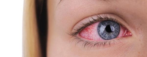 Ini Penyebab Mata Anak Belekan: Virus Atau Bakteri?