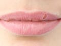 6 Faktor Risiko Tumbuhnya Jamur Di Bibir, Angular Cheilitis Karena Liur