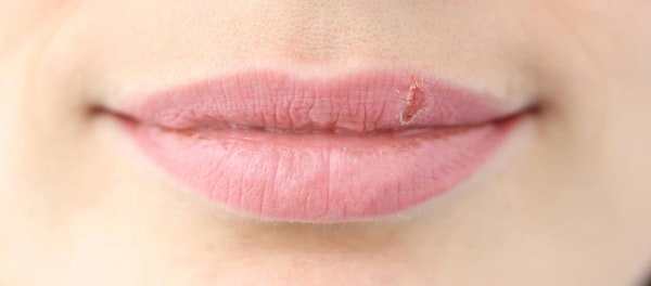 6 Faktor Risiko Tumbuhnya Jamur Di Bibir, Angular Cheilitis Karena Liur
