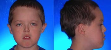 Kebiasaan Anak Bernapas Lewat Mulut, Waspada Dengan Long Face Syndrome