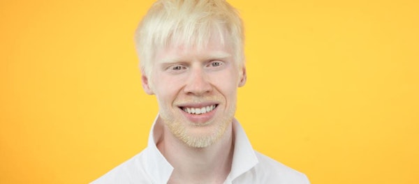 Kelainan Genetik Unik, Ketahui Fakta Tentang Penyakit Albino
