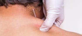 Masih Ada Harapan! Tangani Anak Alergi Dengan Terapi Akupunktur