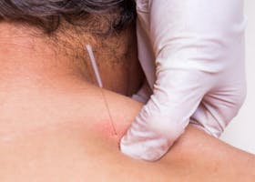 Masih Ada Harapan! Tangani Anak Alergi Dengan Terapi Akupunktur