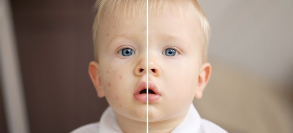 Mengatasi Reaksi Alergi Parah (Anaphilaksis) Pada Anak