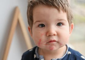 Mengenal Lebih Dekat Dermatitis Pada Anak : Atopik vs Kontak