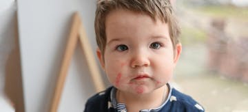 Mengenal Lebih Dekat Dermatitis Pada Anak : Atopik vs Kontak
