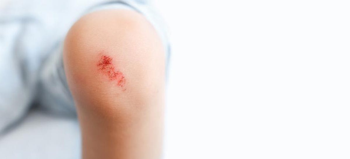 Menyembuhkan Luka Anak Pakai Obat Apa Ibupedia