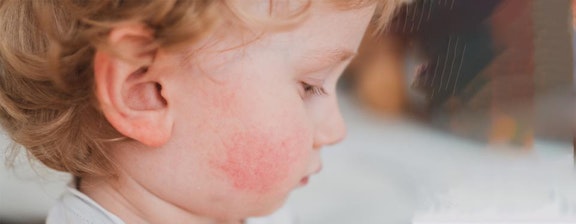 Penyakit Kelima (Fifth Disease), Apakah Itu?