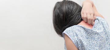 Penyebab dan Penanganan Kudis Pada Anak