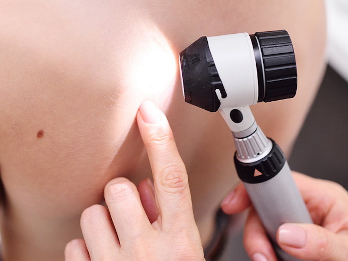 Tahi Lalat Dan Tanda Lahir Pada Anak Ibupedia